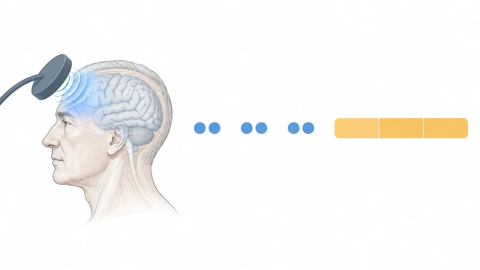 Schematic of a coil near an adult’s left frontal region, six treatment markers in three pairs, and a separate three-month follow-up span.