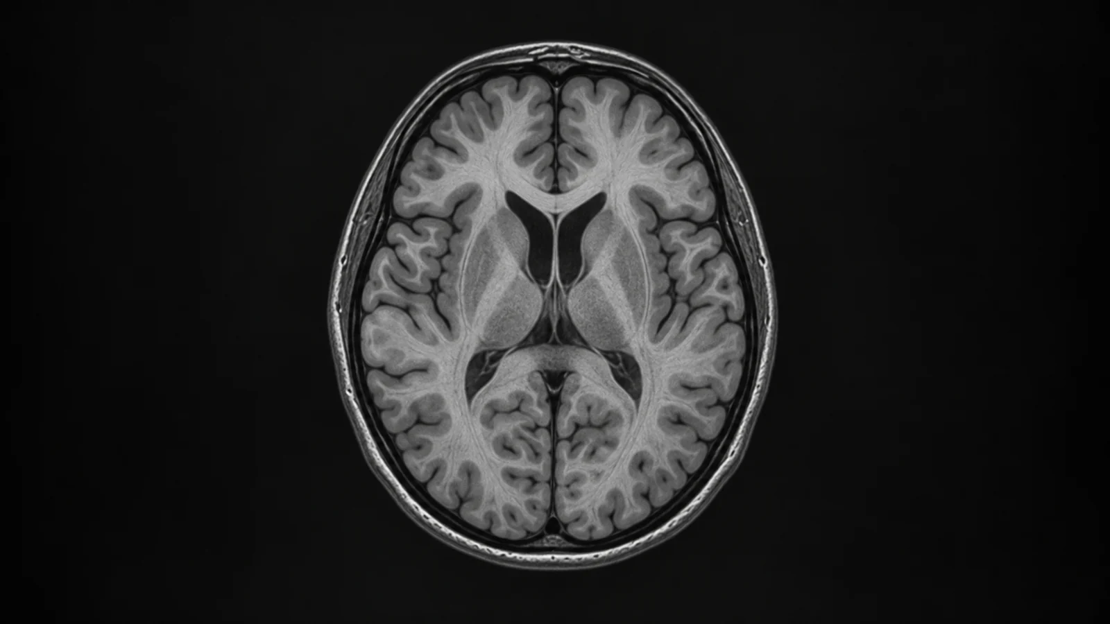 Glymphatic MRI markers in REM sleep behavior disorder