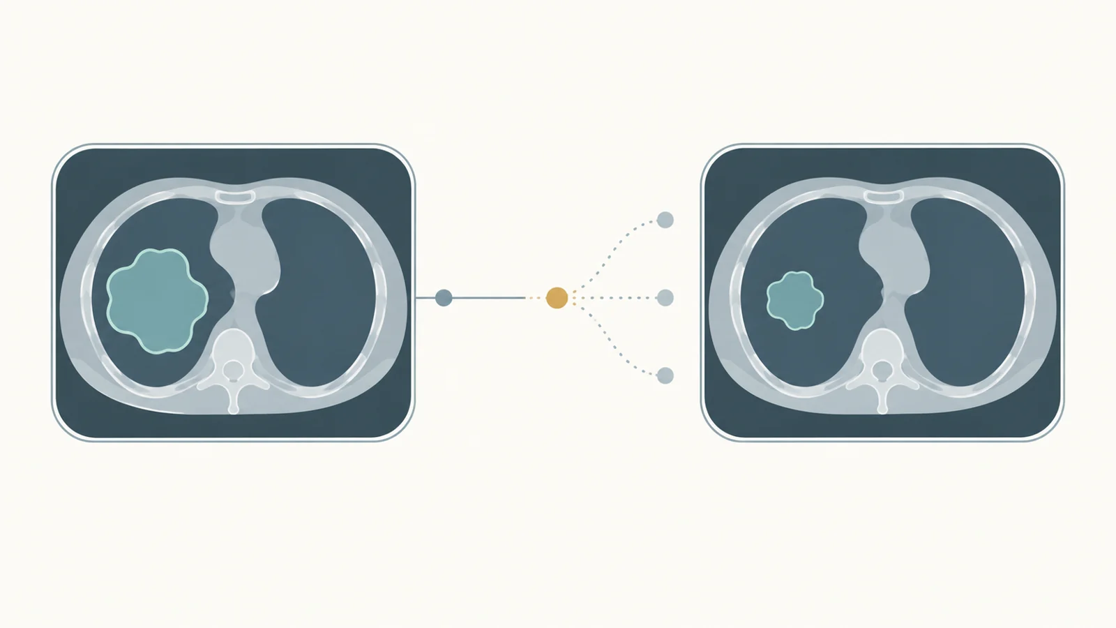 What can a worsening scan mean during cancer immunotherapy?